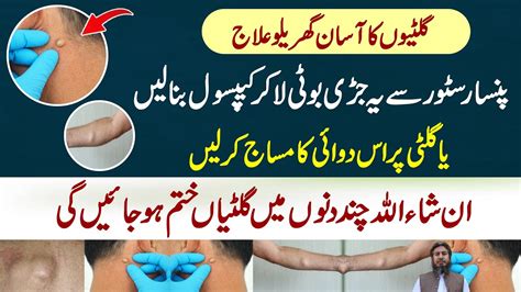 Charbi Ki Gilti Ka Ilaj Giltiyon Ka Ilaj Lipoma Treatment At Home