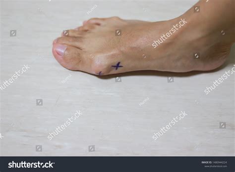 Doctor Mark Asian Girls Feet Hallux Stock Photo 1480944224 | Shutterstock