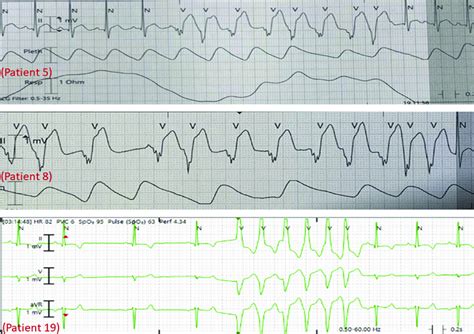 Nonsustained Ventricular Tachycardia Noted In Patients 5 8 And 19 Download Scientific Diagram