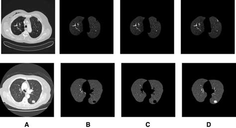 Comparison of segmentation results. (A) CT images (CT-5,6). (B) Lung... | Download Scientific ...