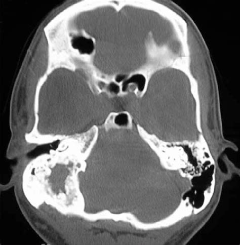 Computerized Tomography Ct Scan Showing Expansile Lesion Of The Download Scientific Diagram