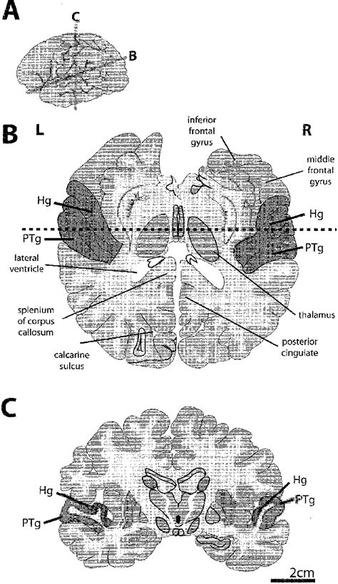 Auditory And Speech Processing Cortex Of The Temporal Lobes A A