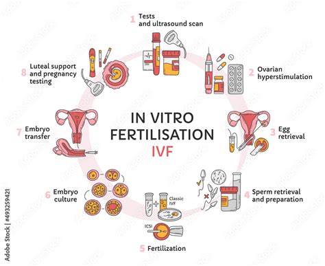 In Vitro Fertilization Ivf Vector Circle Infographic Infertility Treatment Scheme Ovarian