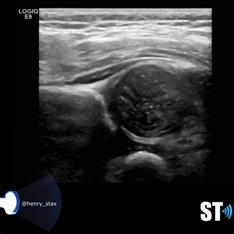 Neonatal Hip Ultrasound