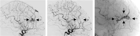 Universit Tsklinikum Heidelberg Neuroradiologie Therapie