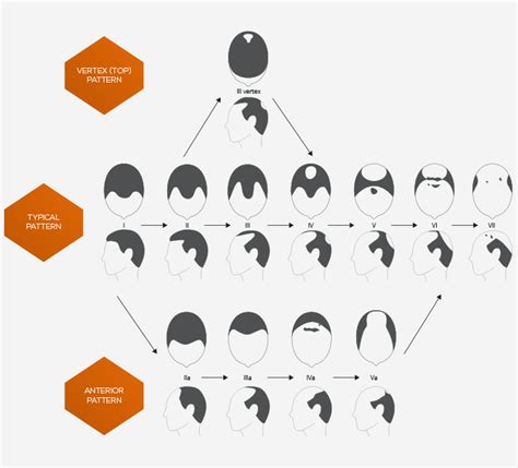 What Causes Male Pattern Baldness Hair Restoration