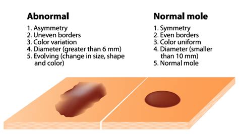 Moles What To Look For And When To Worry