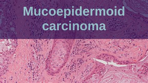 Mucoepidermoid Carcinoma Of Salivary Glands Pathology Mini Tutorial Youtube