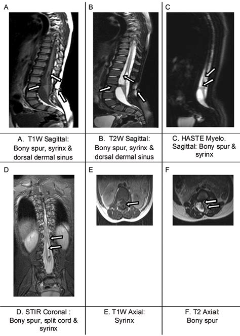 Spina Bifida Occulta Mri