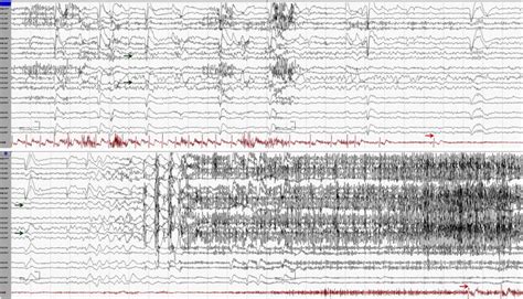 Ictal Asystole Sample EEG From Case 1 Demonstrating An Electrographic