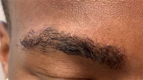 Dallas 5 Month Early African American Male Eyebrow Transplant Close Up