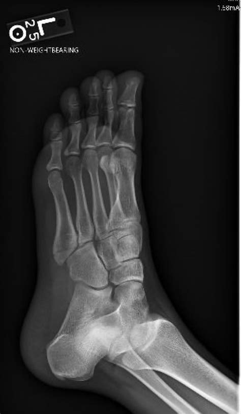 Case Report Fifth Metatarsal Fracture Sports Medicine Review