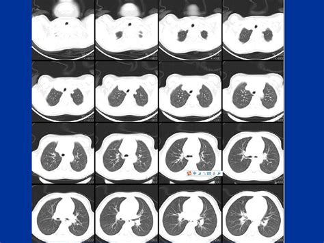 肺部常见疾病ct读片word文档在线阅读与下载无忧文档