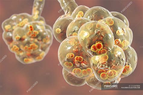 Digital Artwork Of Streptococcus Pneumoniae Bacteria Inside Alveoli Of