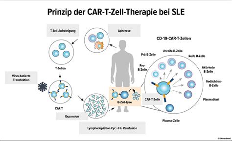 CAR T Zell Therapie Beim Systemischen Lupus Ein Neuer Meilenstein