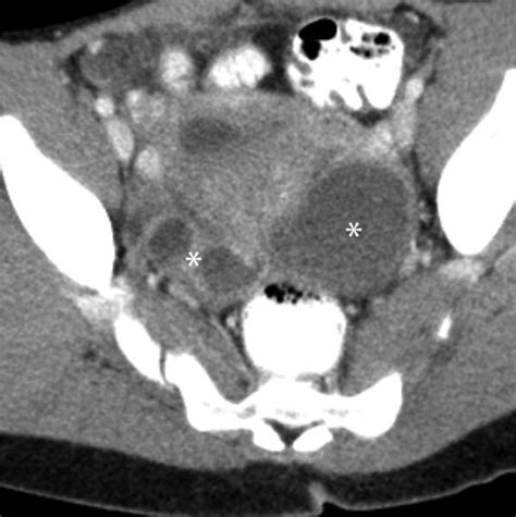 Tubo Ovarian Abscesses Contrast Enhanced Computed Tomography Scan From