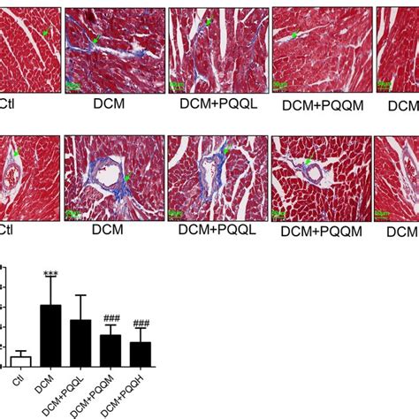 The Effects Of Pqq On Cell Viability And Pyroptosis Signaling In Ac