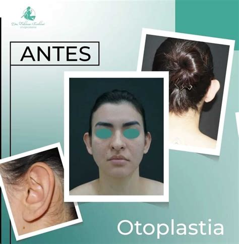 Otoplastia Guia Saúde Cidades