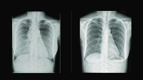 Figure E2 Preoperative Left And Postoperative Right Radiographs Of Download Scientific