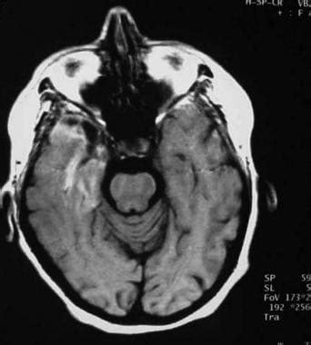 Herpes Simplex Encephalitis Workup Approach Considerations Magnetic