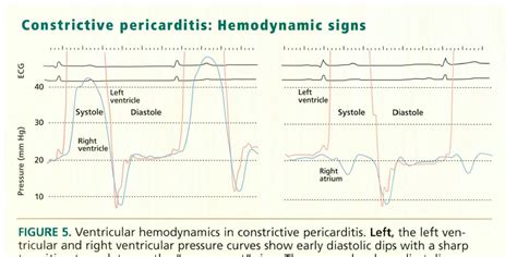 Constrictive Pericarditis Ecg