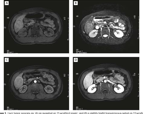 Nodular Regenerative Hyperplasia