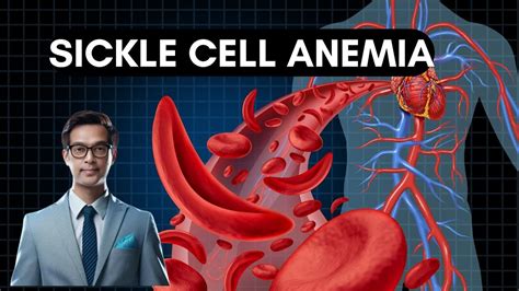 Sickle Cell Anemia I Top Notch Notes I High Yield Mcqs For Mbbs Neet