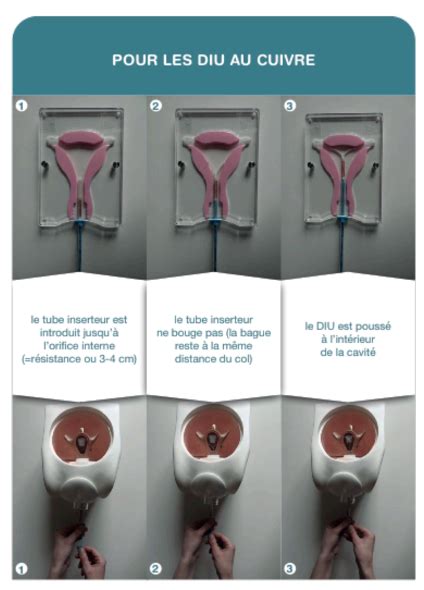 Diu En M Thode Torpille Et Examen Clinique Des Seins