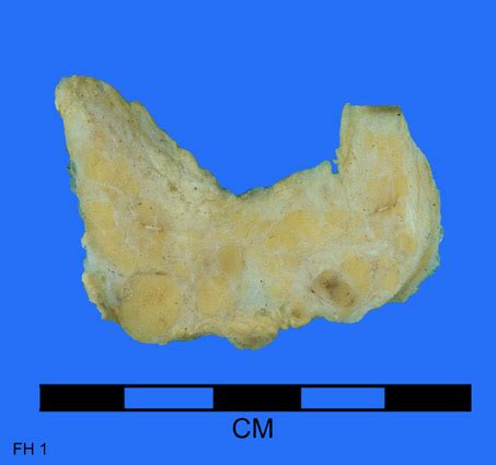 Thyroid Atrophy - Museum of Pathology