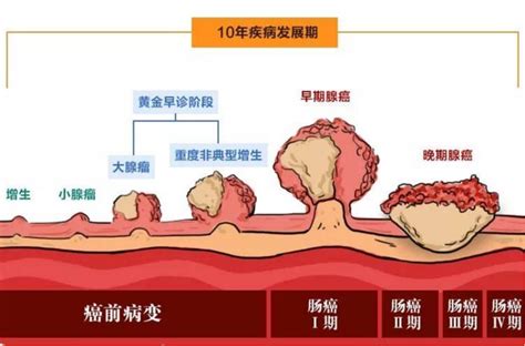 漫漫肠路上隐藏的深水炸弹大肠息肉你不得不防 凤凰网