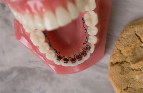 Hidden Braces At Vco Orthodontics Arlington Va By Orthodontist