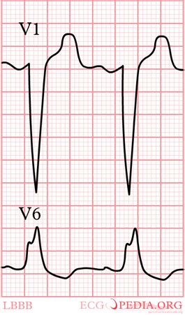 Intraventricular Conduction - ECGpedia