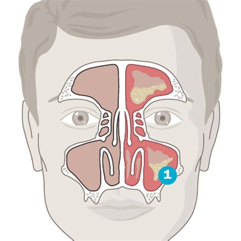 Sinusitis Op Wie Lange Krank Hotsell Pacificproductsandservices