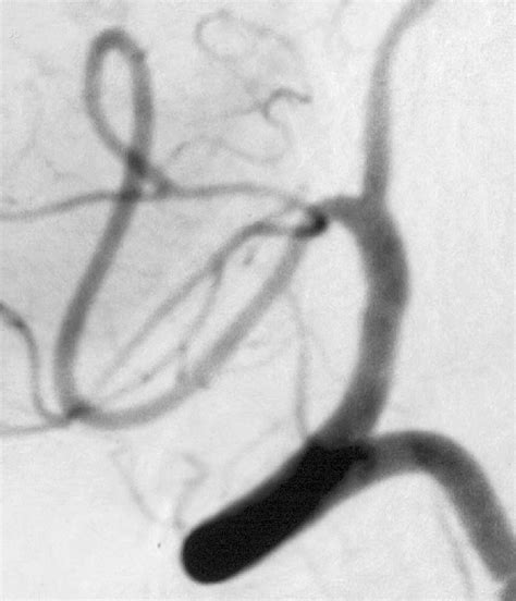 Magnified Lateral Dsa Image Of The Right Vertebral Artery After