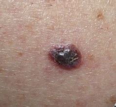 Melanoma Pictures And Malignant Tumor Of The Skin Online Dermatology