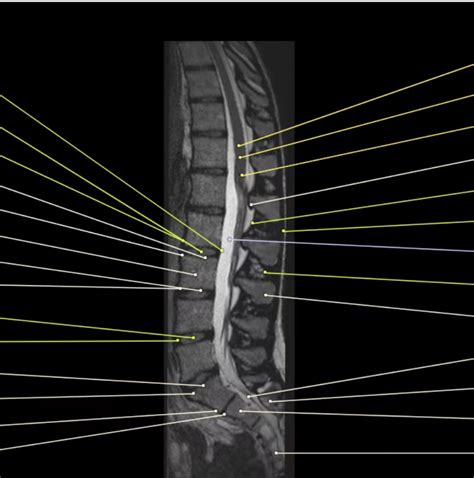 Sagittal Lumbar Anatomy MRI Normal Diagram Quizlet