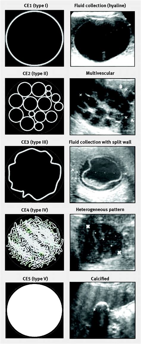 Diagnosis Treatment And Management Of Echinococcosis The Bmj