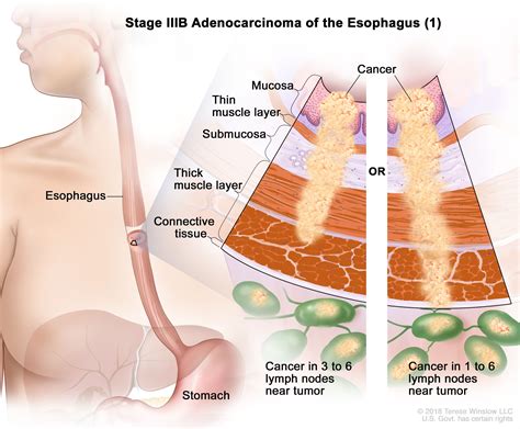 Esophageal Cancer Treatment Nci