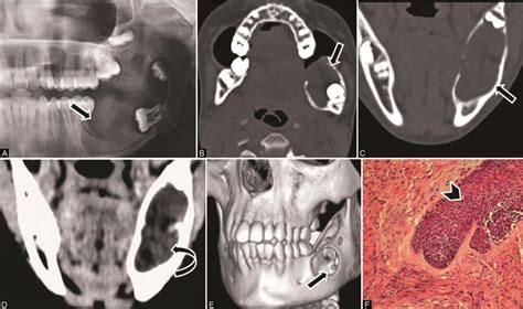 Ameloblastoma In A 12 Year Old Boy With A Swelling Left Lower Jaw A