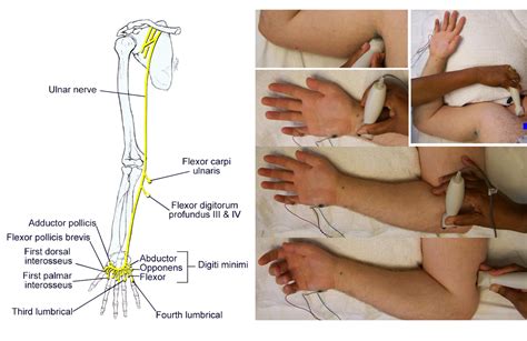 Nerve Entrapment Exercises For Radial Nerve Entrapment