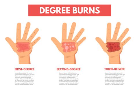 166 BEST First Degree Burn IMAGES, STOCK PHOTOS & VECTORS | Adobe Stock