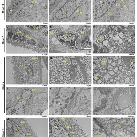 Ultrastructural Changes In Sars Cov Infected Placental Cells And