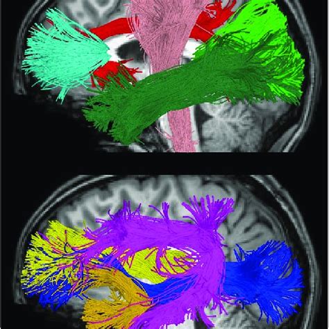 Major White Matter Tracts Used In The Present Study Visualized Using