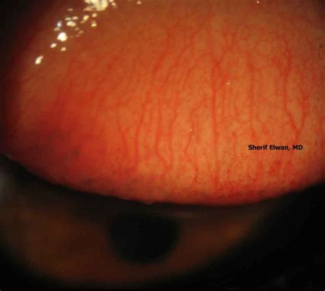 26.Conjunctival Papillae photo - Sherif Elwan photos at pbase.com