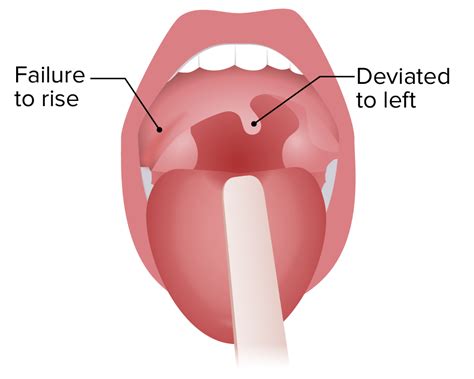 Cranial Nerve Palsies Concise Medical Knowledge