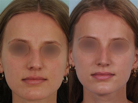 Rhinoplastie Avant Apr S Photos Et Exemples De Nez Refaits