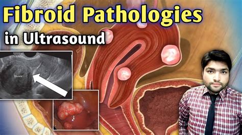 Fibroids Pathologies In Uterus Ultrasound By Dr Ali Waqar Youtube