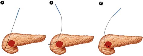 Irreversible Electroporation For Locally Advanced Pancreatic Cancer