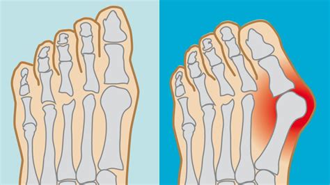 Hallux valgus schickt großen Zeh auf schiefe Bahn WELT