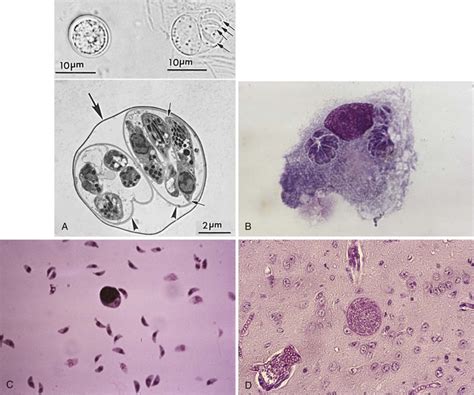 Toxoplasma Gondii Oncohema Key